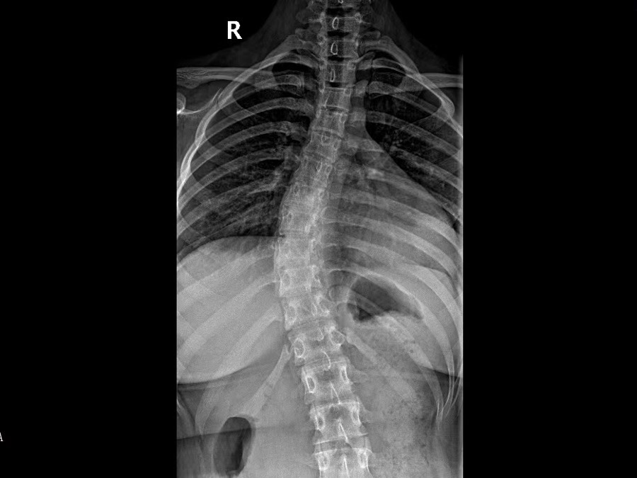 脊柱侧弯，定期筛查、尽早干预很重要！