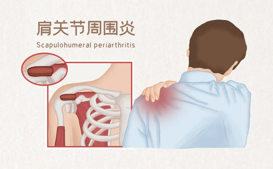 健康科普丨肩“弱不禁风”的秘密——肩周炎