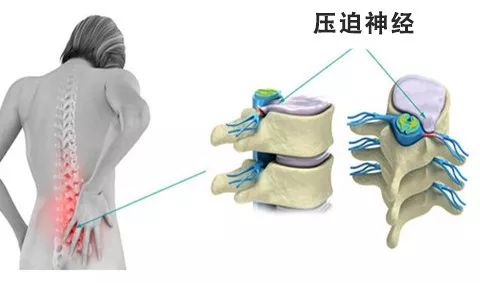 腰椎间盘突出症，大多数的患者并不需要手术