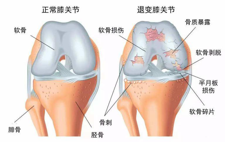 隐藏在身上的退行性骨关节病，你都了解吗？