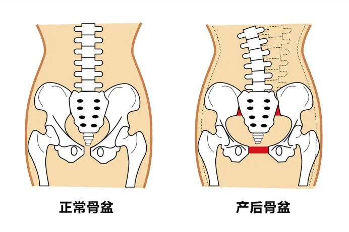 产后腰痛究竟是不是“月子”没做好？有可能是骨盆歪了