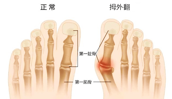 拇外翻是不是病？该不该治？